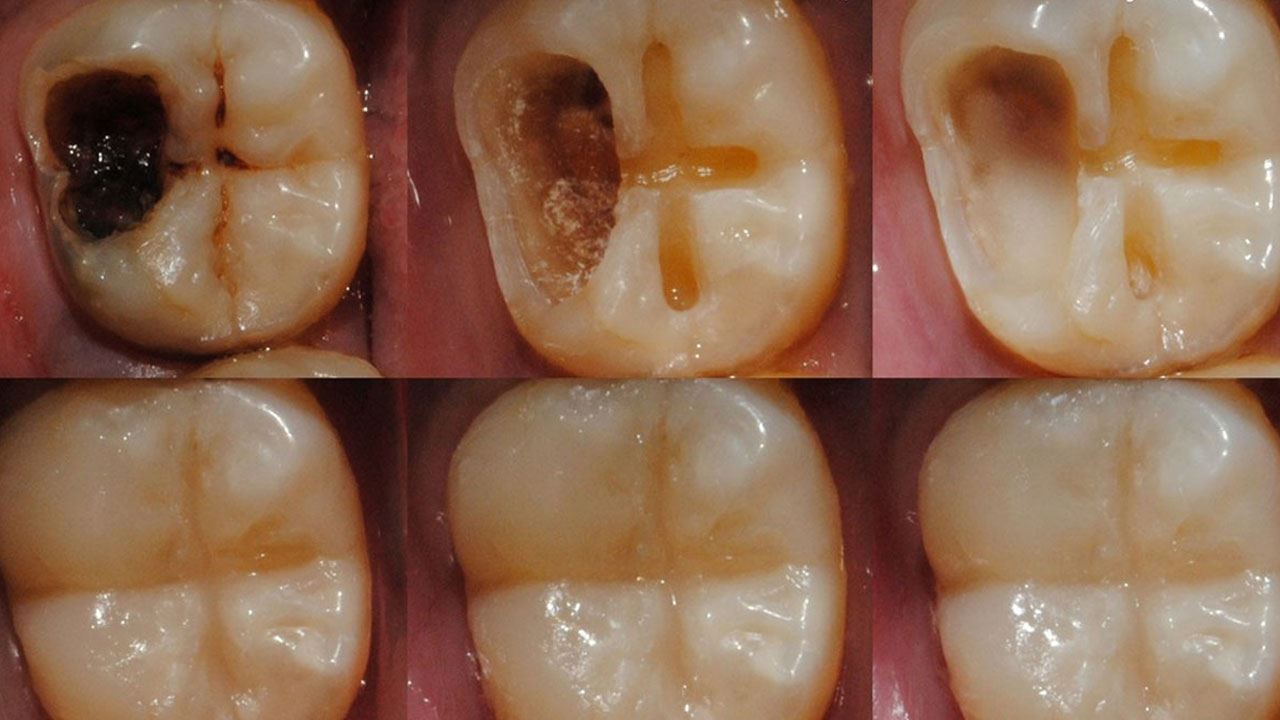 Reverse Tooth Decay