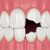 7 Options To Fix a Broken Tooth